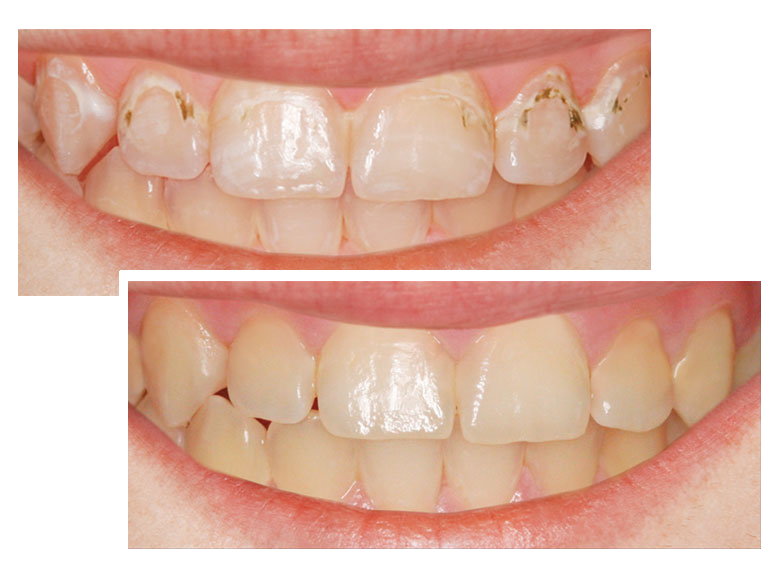 Лечение на кариес